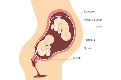 Dubbele Zwangerschap Anatomie Van De Baarmoeder Met Tweelingfoetussen