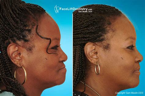 TMJ Surgery Before And After