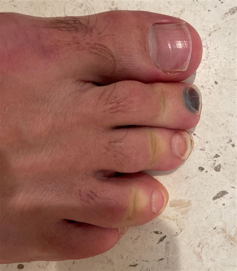 Black Toenails Causes Prevention Tips And How To Treat Atelier