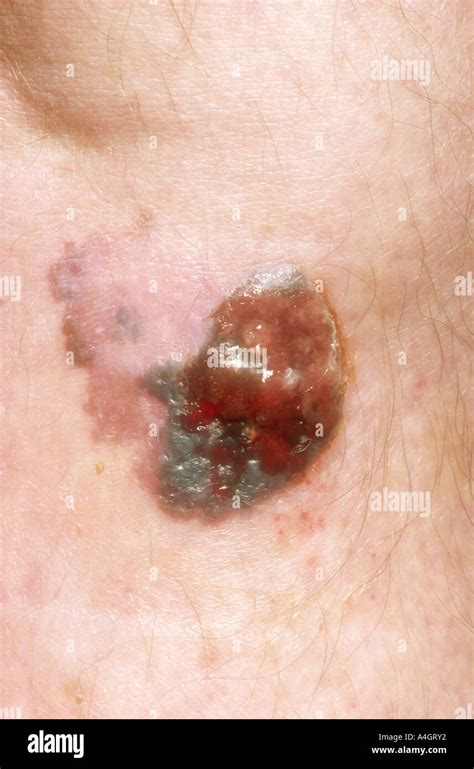 Nodular Malignant Melanoma Hi Res Stock Photography And Images Alamy