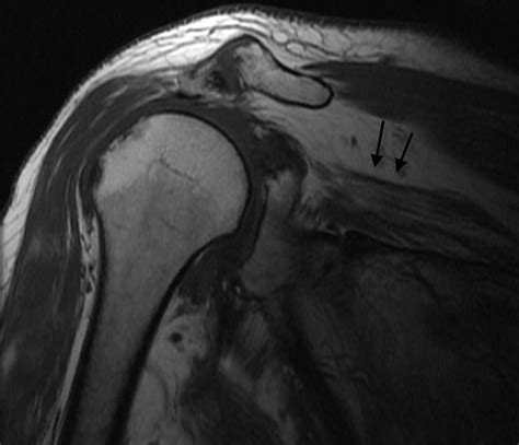 Rotator Cuff Tear Image