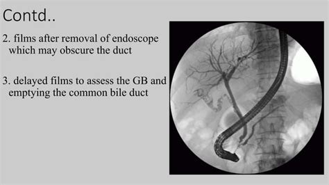 Procedure Of Ercp And T Tube Cholangiography Ppt