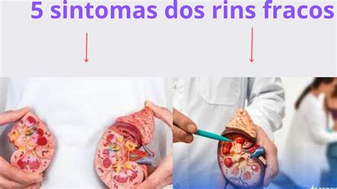 Principais Sintomas De Problemas Nos Rins YouTube