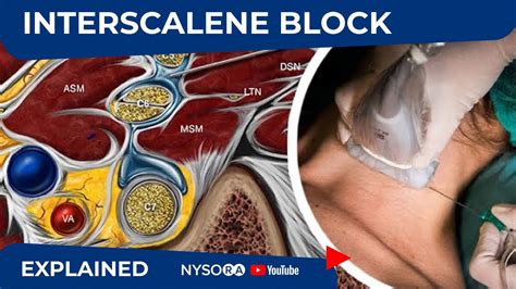 Ultrasound Guided Interscalene Brachial Plexus Block Youtube Images