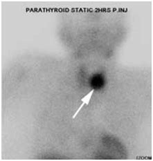 Dual Parathyroid Pathology A Common Failure Of Technetium Sestamibi