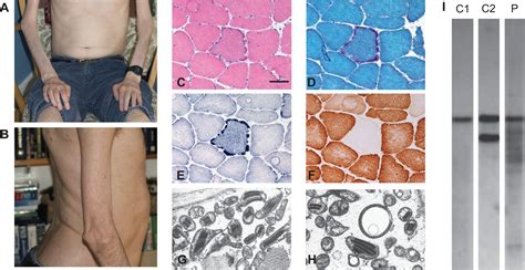 Distal Myopathy With Cachexia An Unrecognised Phenotype Caused By