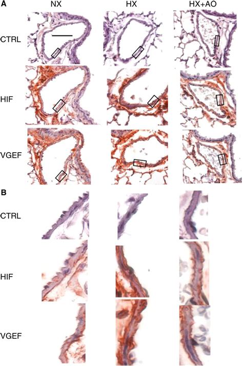 Immunohistochemical staining for HIF 1α and VEGF A Representative