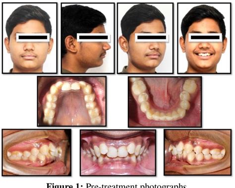 Figure 1 From Class II Correction With Forsus Fixed Functional