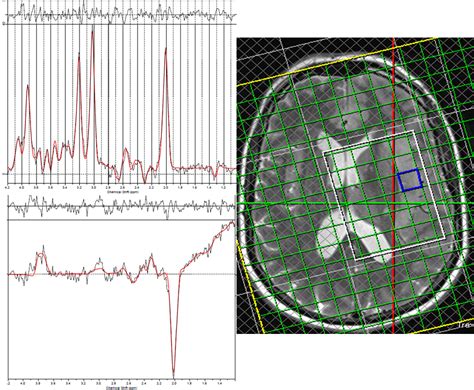 Figure 2 An Edited And A Non Edited Spectra From An Idh Wild Type Patient