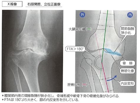 変形性膝関節症ってなに？ にしあらい整形外科｜西新井駅の整形外科