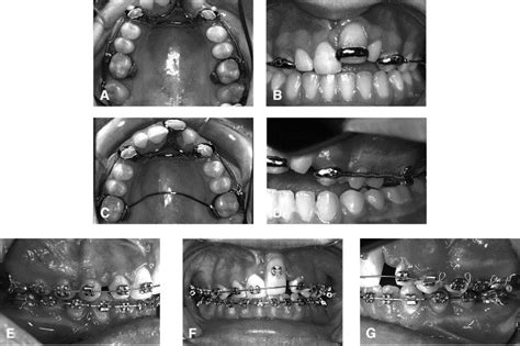 Treatment Of An Ankylosed Central Incisor By Single Tooth Dento Osseous Osteotomy And A Simple