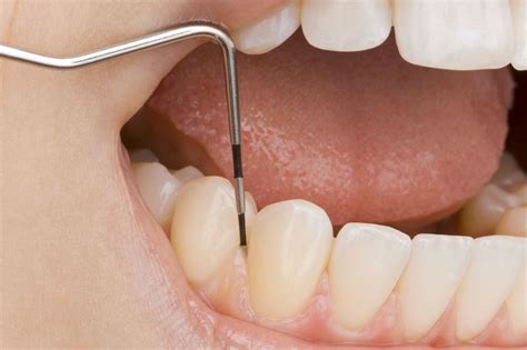 Scaling Deep Cleaning Periodontal Therapy The Brooklyn Dentist