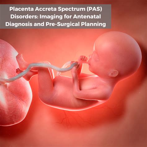 Event Placenta Accreta Spectrum Disorders