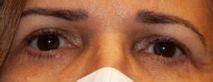 Avoiding Potential Lower Eyelid Surgery Complications