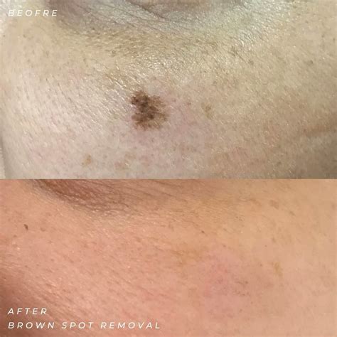 Birthmark Removal Before And After