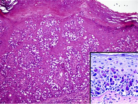 Figure 2 From Extramammary Paget S Disease Of The Penis And Scrotum Semantic Scholar