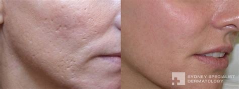 Laser Surgery Fraxel Acne Cosmetic Laser Surgery Pictures