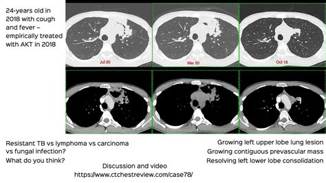 Lung Mass - CT Chest Review