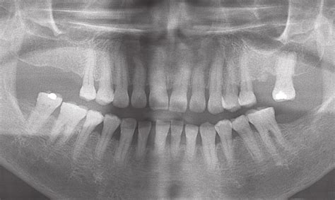 Pretreatment Radiograph Of Case Generalized Horizontal Alveolar Bone