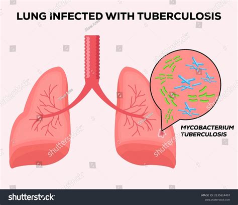 Human Lungs Infected Tuberculosis Stock Vector Royalty Free