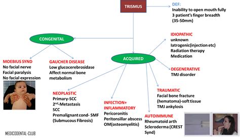 MEDICODENTAL: TRISMUS