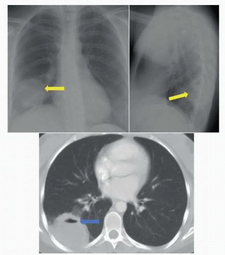 Lung Abscess Ct Scan