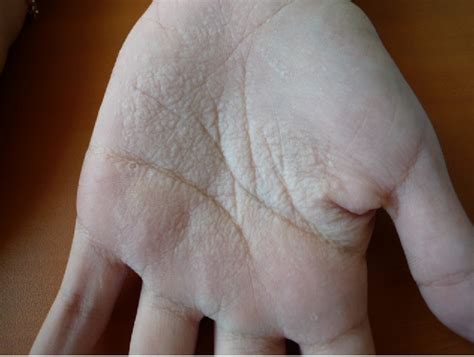 Figure From Aquagenic Palmar Keratoderma In A Patient Heterozygous