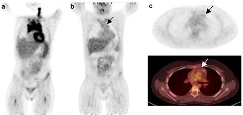 Pdf Inter Reader Reliability Of Early Fdg Pet Ct Response Assessment