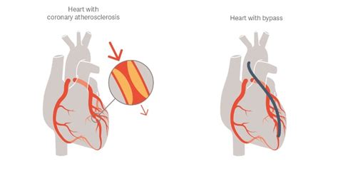 Cirurgia De Revascularização Miocárdica Crm