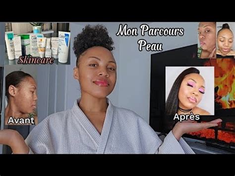 SKINCARE COMMENT J AI REUSSI À TRAITER MES PROBLÈMES DE PEAU