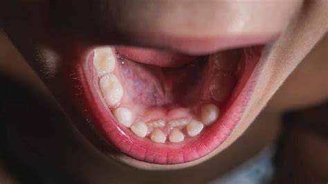 Frenectomy In The Uk Indications And Course Of The Procedure