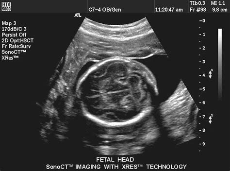 Normal Fetal Brain Ultrasound Anatomy