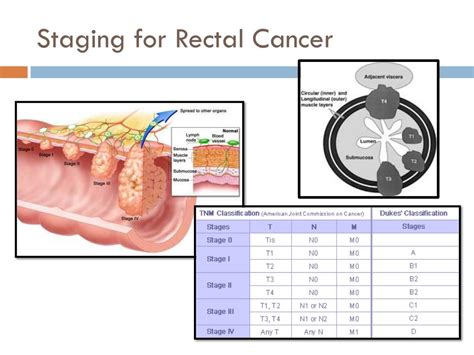 Rectal Cancer T Stage