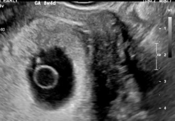 The Exciting World of 3 Weeks Pregnant Ultrasound: What to Expect - USA ...