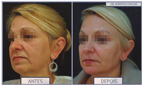 Preenchimento Maçã Do Rosto Antes E Depois - PREENCHIMENTO DAS MAÇÃS DO ROSTO - Dr. Roberto Chacur