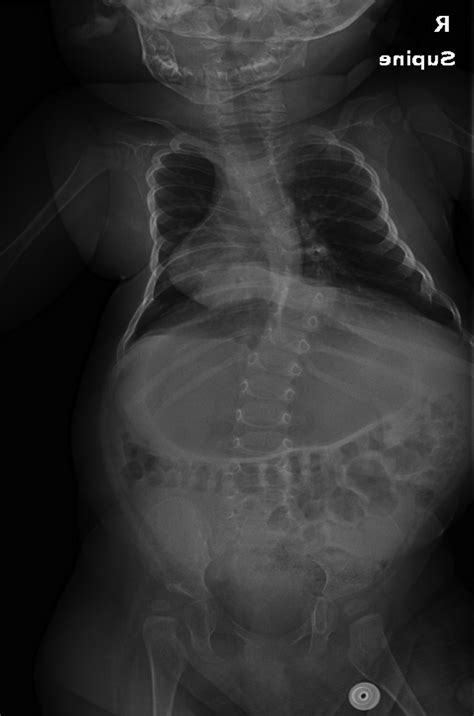 Evolving Surgical Management for Early-Onset Scoliosis in Sp... : JBJS