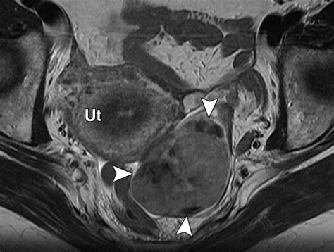 T2 Hypointense Adnexal Lesions An Imaging Algorithm Radiographics