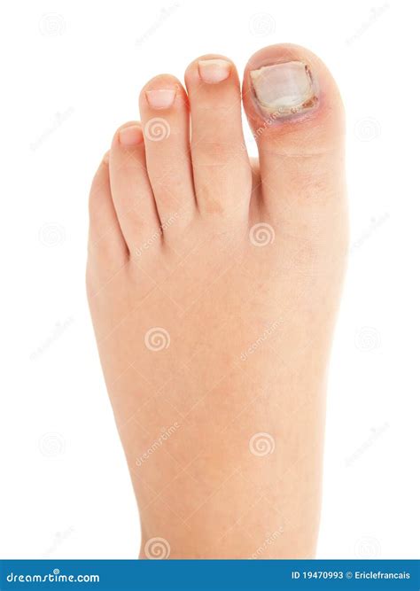 Broken Big Toe with Nail Detachment Stock Image - Image of injury, foot