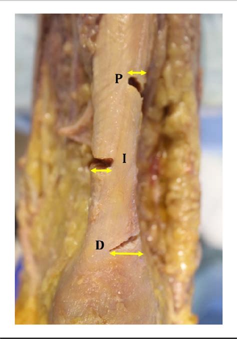 Figure From Anatomic Evaluation Of Percutaneous Achilles Tendon