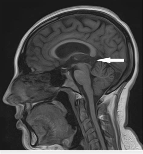 T1 Weighted Non Enhanced Sagittal Magnetic Resonance Imaging Mri