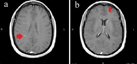 Normal Brain Mri With Contrast Images Radiologia