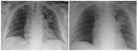 Radiation Fibrosis Lung