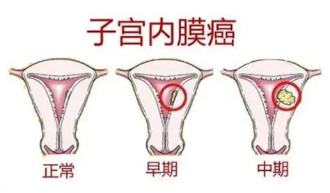 年龄不到50岁的女性，有这些表现，一定要筛查子宫内膜癌 子宫内膜癌 阴道 绝经 月经 健康界