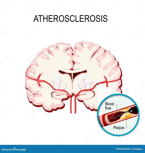 Atherosclerosis Of Brain Vessels Cartoon Vector | CartoonDealer.com ...