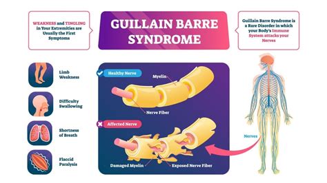 Guillain-Barré Syndrome Treatment - Propel Physiotherapy