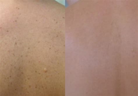 Laser Skin Rejuvenation Laser Of Arlington