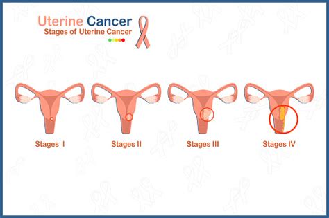 Stages Of Uterine Cancer Stock Illustration - Download Image Now ...