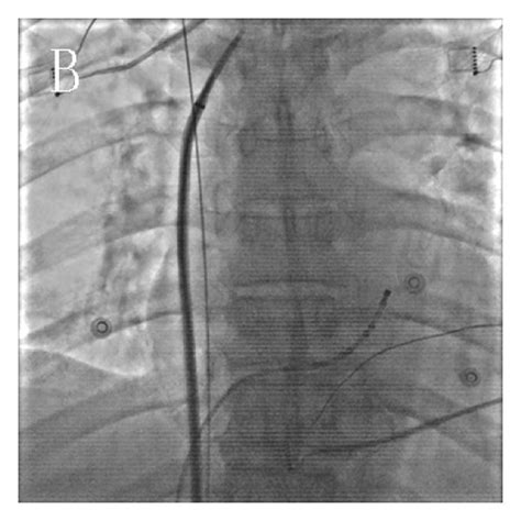 Transseptal Puncture With Fluoroscopy A At The Right Anterior