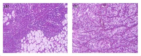 Pathological Figures Of Angiomyolipoma And Clear Cell Renal Cell