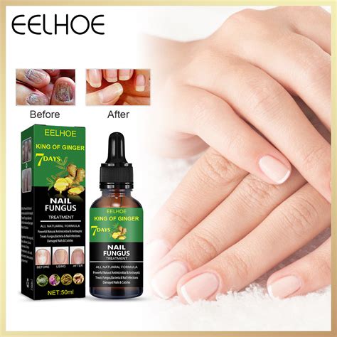 Eelhoe Professional Foot Anti Fungal Treatment Solution To Remove